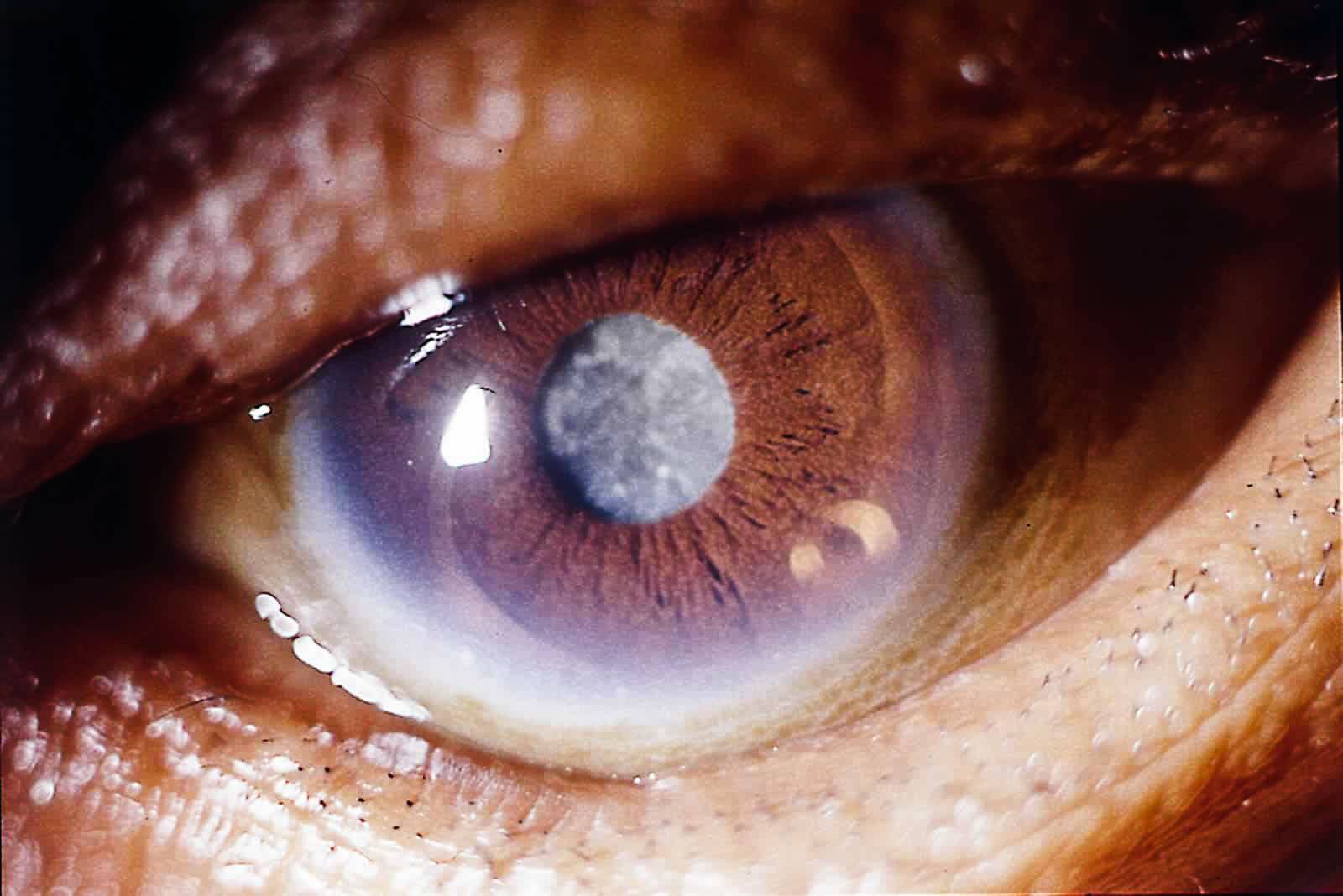 Артифакия одного или двух глаз — что это такое, нужно ли лечить