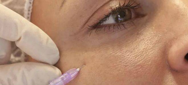 Мезотерапия вокруг глаз: основные области обработки, какие препараты используют от морщин на коже для зоны