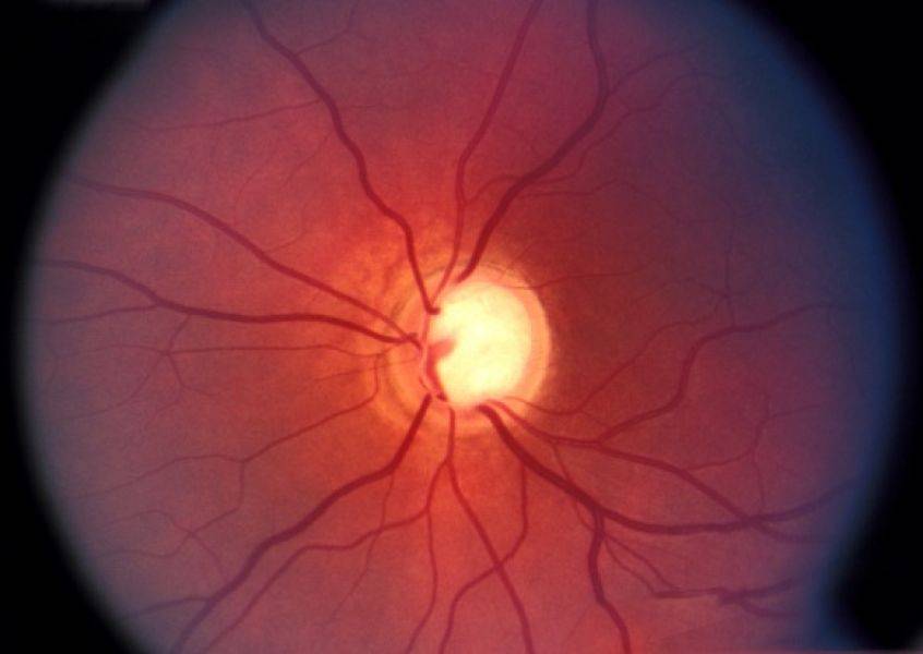 Степени развития глаукомы и способы их лечения