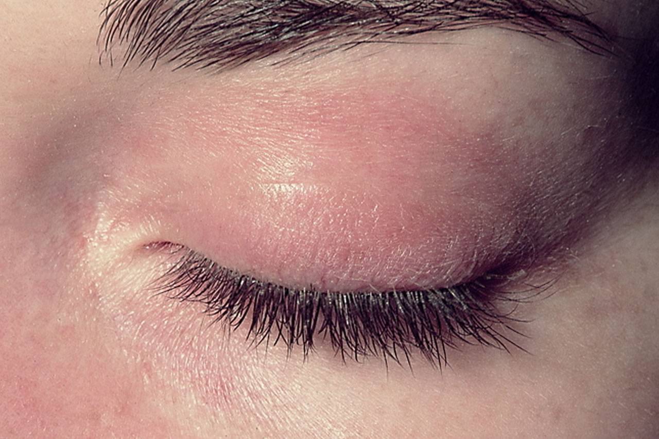 Раздражение вокруг глаз в уголках кожи на веках: лечение капли, симптомы