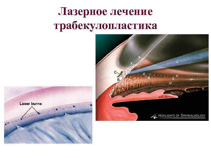 Лазерное лечение глаукомы: трабекулопластика, иридэктомия