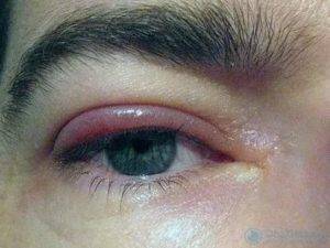 Отеки над глазами: причины, как лечить припухлость верхнего века, что делать если глаз опух внезапно