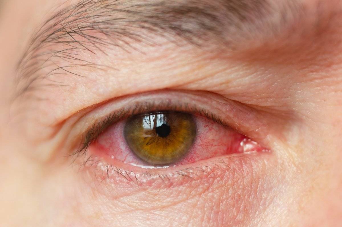 Красные пятна под глазами: причины, лечение, симптомы (точки шелушатся, чешутся, появляются после рвоты) у взрослых и детей