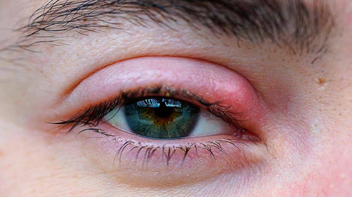 Отеки над глазами: причины, как лечить припухлость верхнего века, что делать если глаз опух внезапно