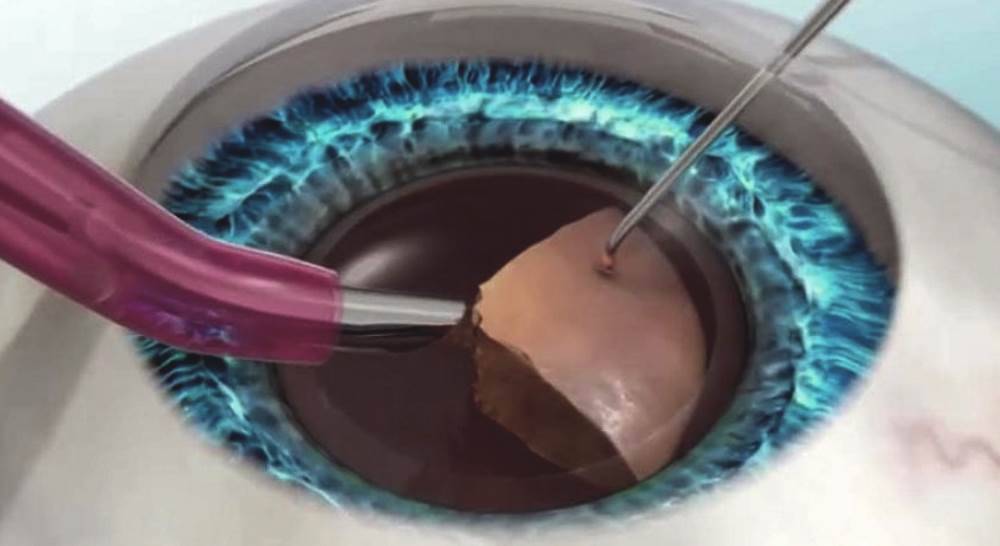 Реабилитация после операции катаракта глаза — послеоперационный период после замены хрусталика