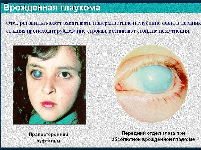 Врожденная глаукома у детей что это такое