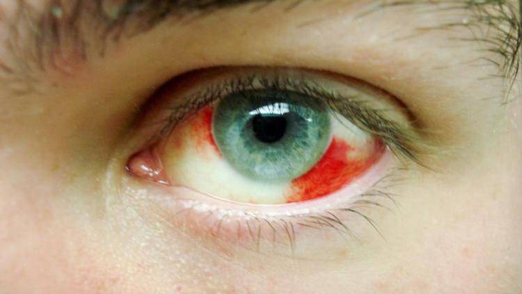 Гематома глаза после удара: лечение, как убрать на веке, под и над ним, вокруг зрительного органа