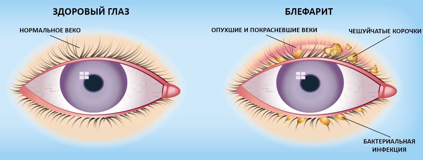 Что делать при воспалении глаз