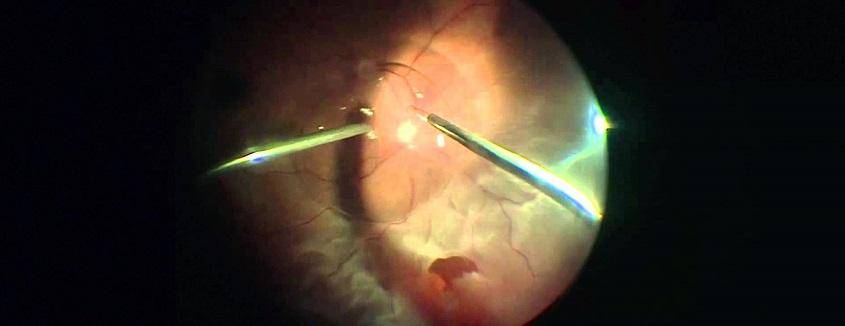 Операции на сетчатке глаза: как проводят при отслойке, разрыве, по укреплению, замена, восстановление после