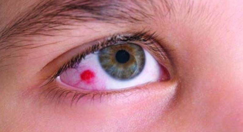 Ретинобластома у детей: симптомы, лечение глаза и причины