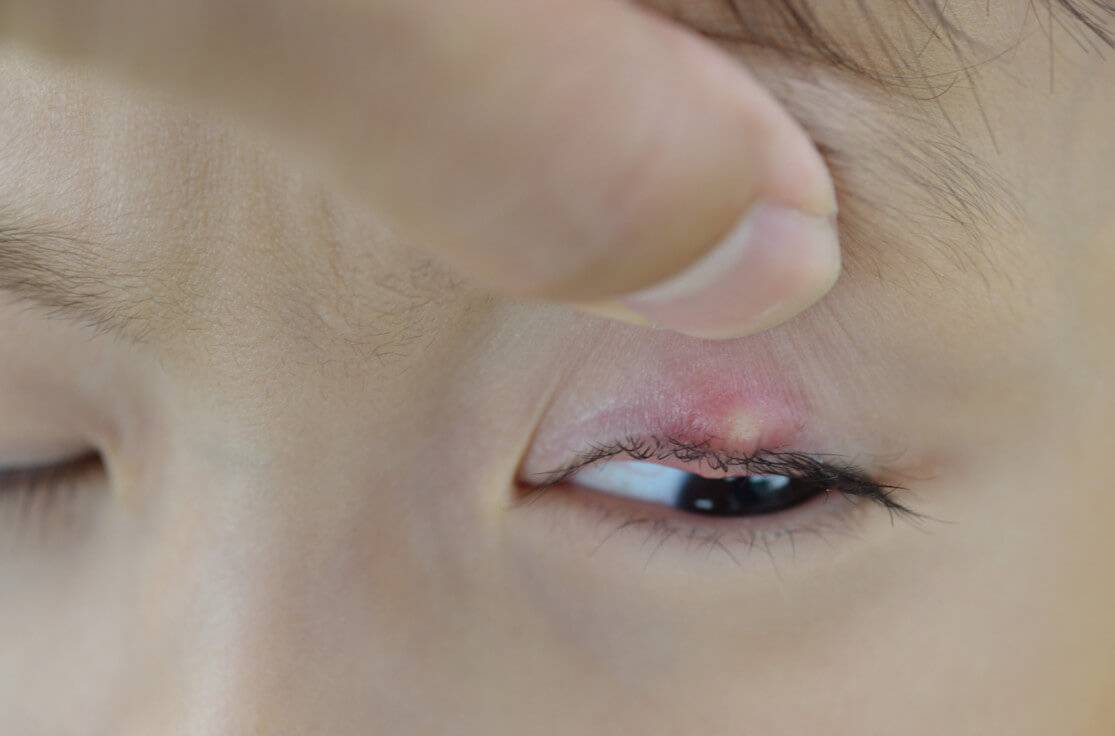 Быстрое и безопасное лечение ячменя на глазу у детей: капли, мази, народные примочки