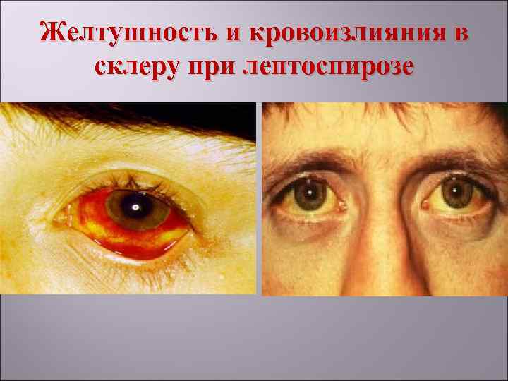 Воспаление эписклеры глаза: причины и симптомы, лечение эписклерита у взрослого и ребёнка