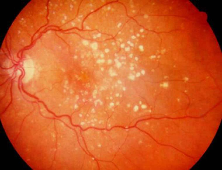 Рекомендации по лечению возрастной макулодистрофии сетчатки глаза: от трав до лазера
