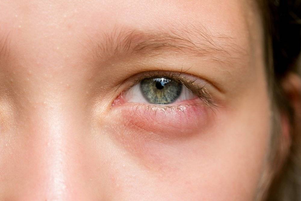 Частые рецидивирующие ячмени на глазах: истинные причины
