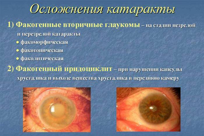 Памятка пациенту с глаукомой для реабилитации: восстановление и ограничения после операции