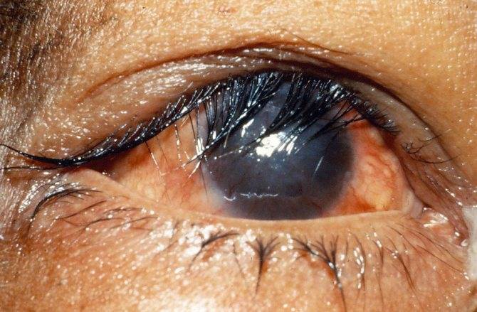 Рак глаза: фото, первые симптомы, лечение
