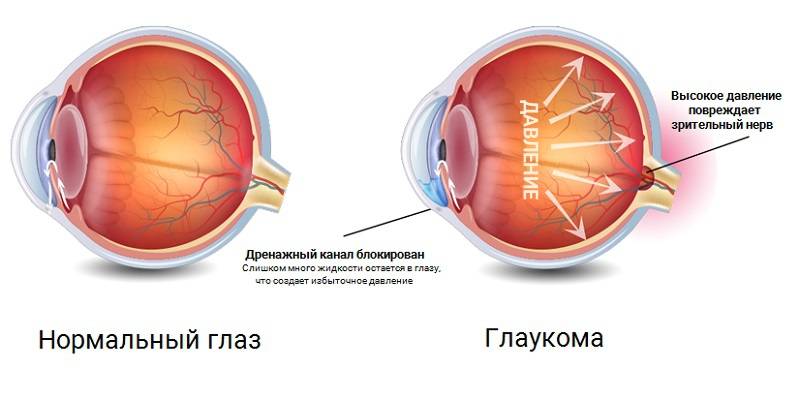 Признаки первичной глаукомы: симптомы и лечение