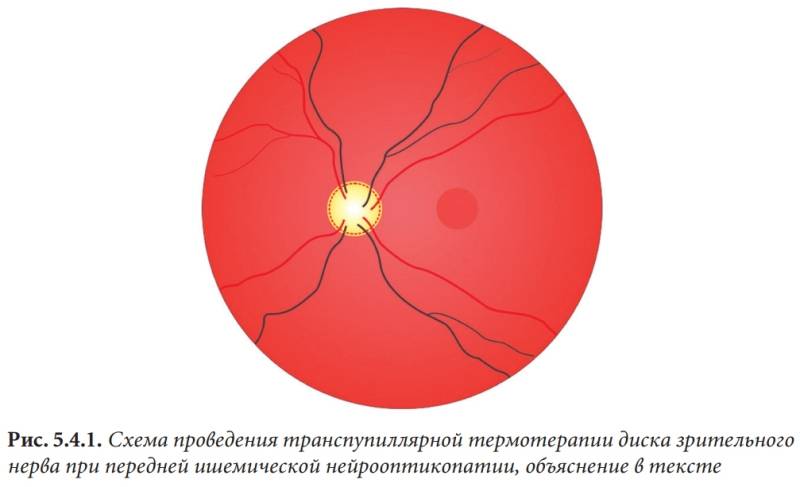 Передняя ишемическая нейропатия зрительного нерва: лечение, глаза