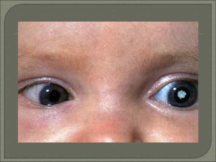 Врожденная катаракта у детей