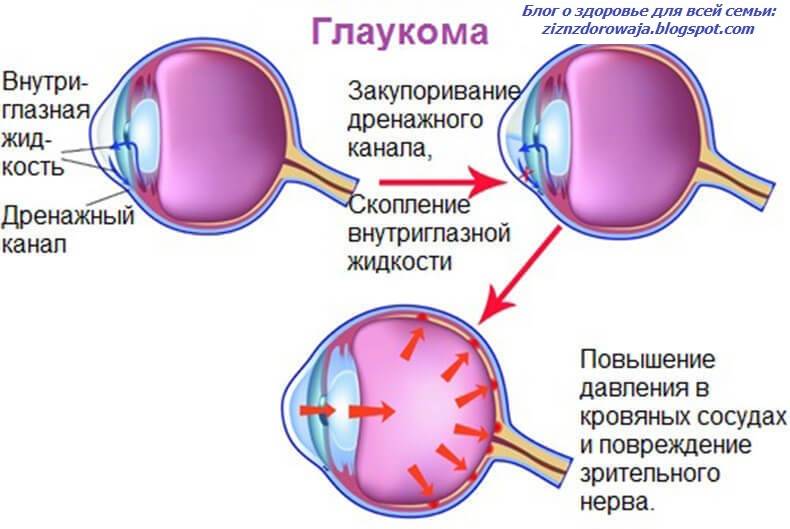Признаки глаукомы. что такое глаукома, лечение — глаза эксперт