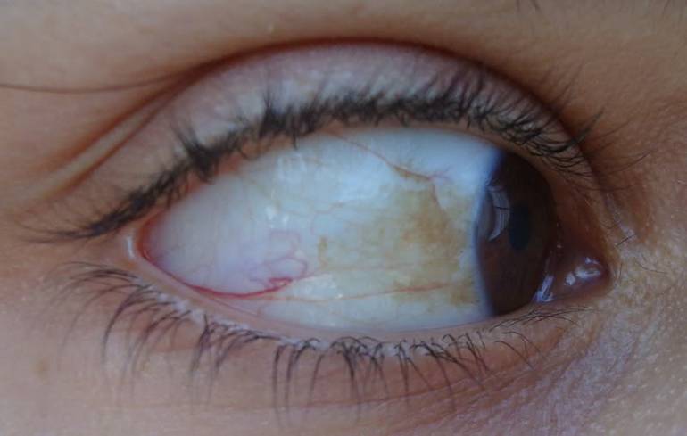 Желтые белки глаз у новорожденных: точка или красное пятно на глазном яблоке, желтоватые склеры у ребенка