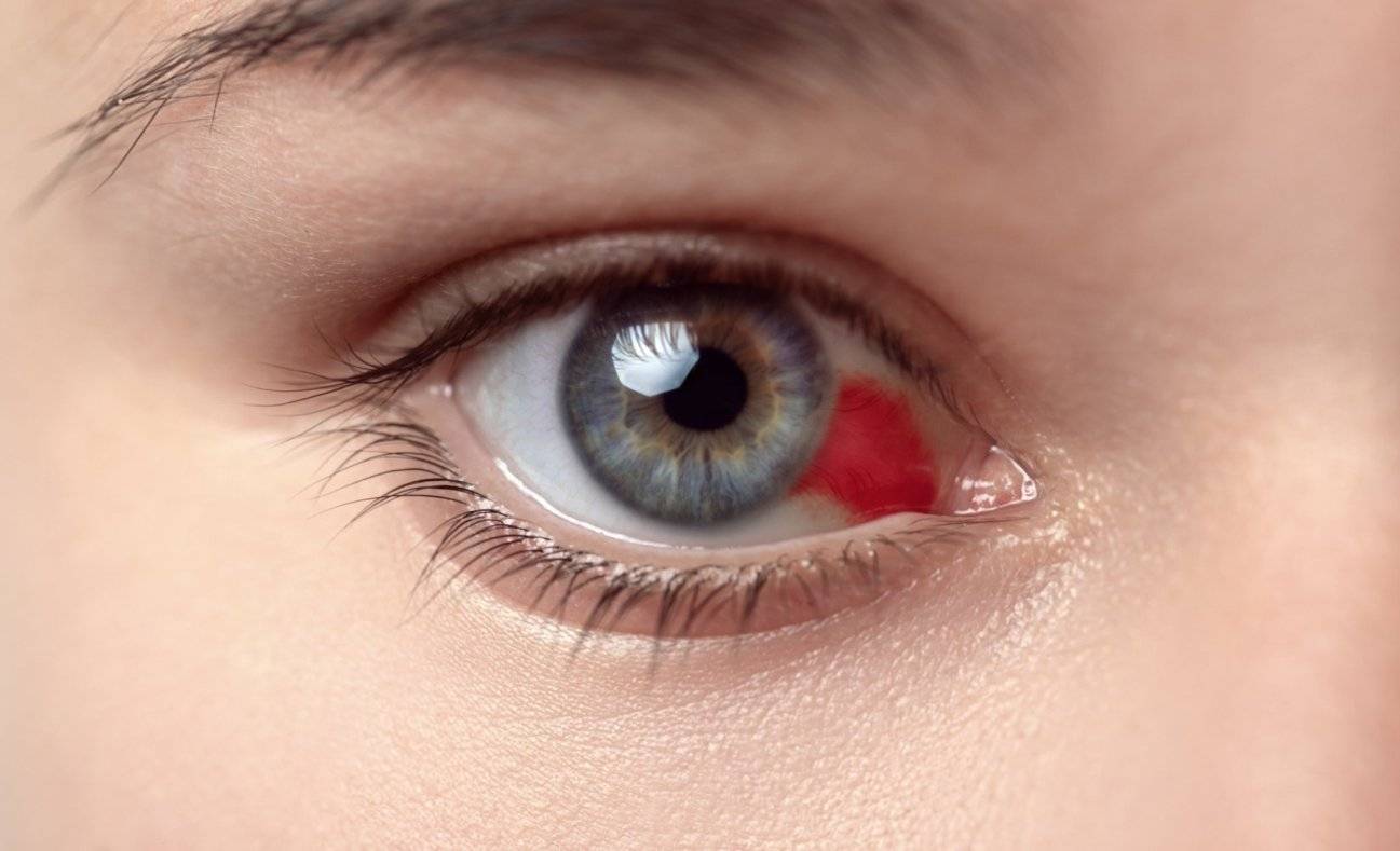 Опасны ли красные пятна в глазах: определение причины и лечение