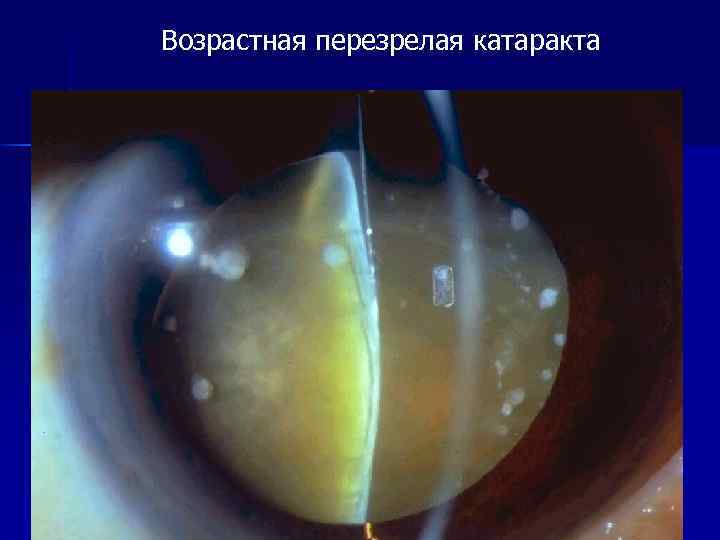 Операция - катаракта на глазе, удаление старческой перезрелой