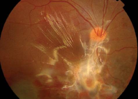 Эпиретинальная мембрана глаза: лечение, как делается операция