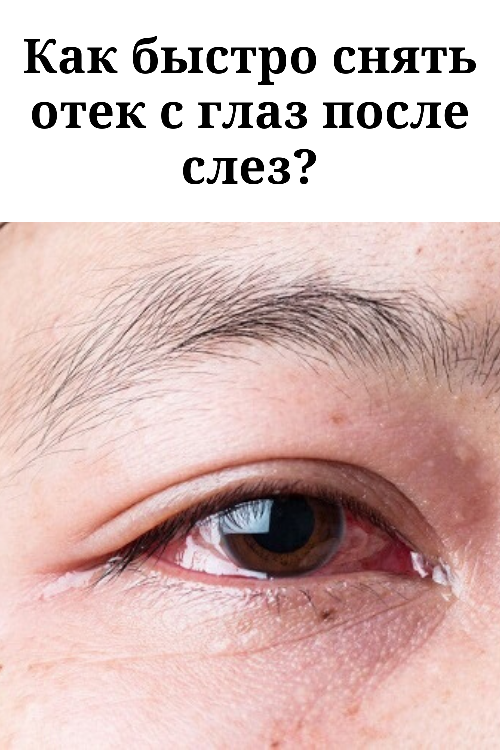 Как быстро снять отеки с глаз после слез: советы, народные рецепты "здоровое око"