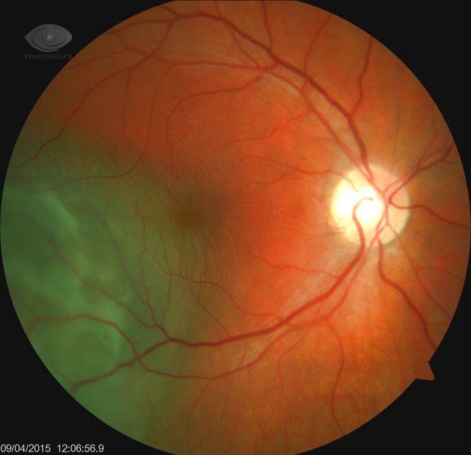 Разрыв сетчатки глаза - от чего бывает и как лечить патологию, ее причины и признаки, последствия и восстановление зрения
