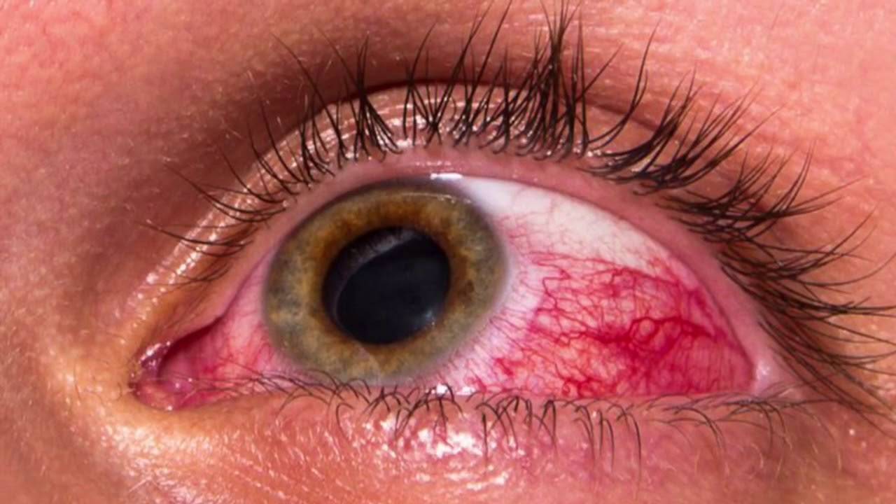 Анатомия сосудов глаза и распространенные заболевания