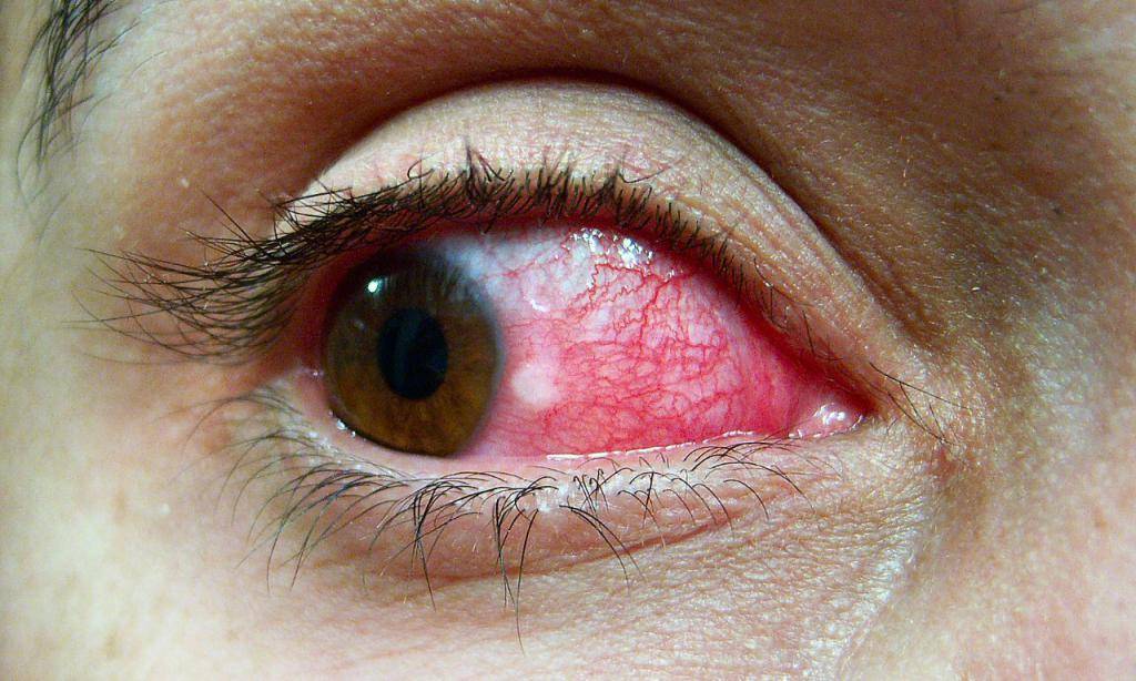 Воспаление и покраснение глаза: лучшие капли и мази для лечения
