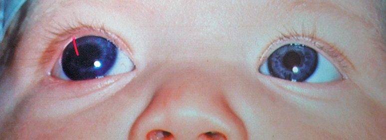 Глаукома у детей | симптомы и лечение глаукомы у детей | компетентно о здоровье на ilive