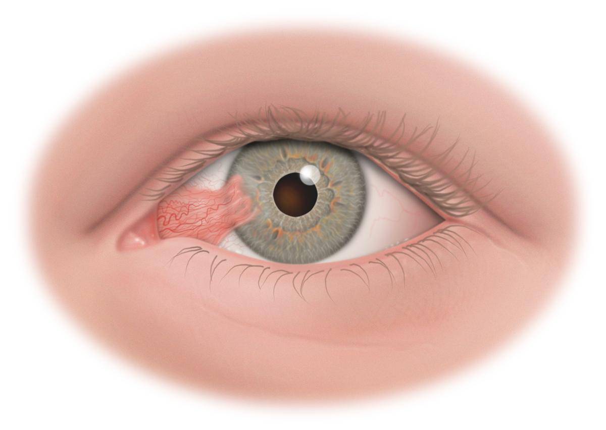 Птеригиум на глазу: что это такое, стадии и степени заболевания, лечение глазной болезни