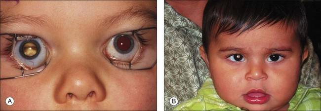 Рак глаза: первые симптомы, современные методы лечения