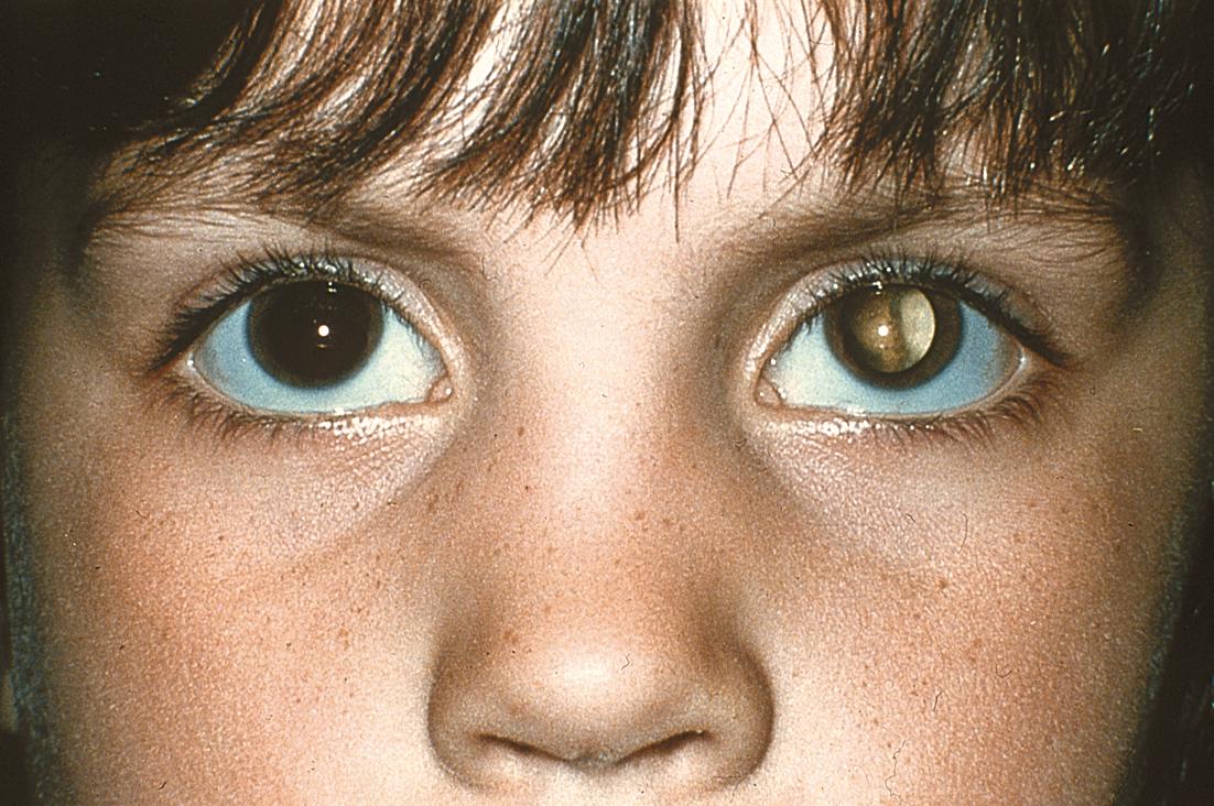 Чем вызвана катаракта в детском возрасте и как ее вылечить?