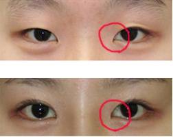 За и против пластической хирургии по увеличению глаз