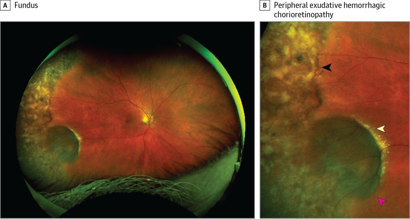 Периферическая дистрофия сетчатки: ретинальные дегенерации обоих глаз, след улитки или пвхрд, булыжная мостовая что это такое, пхрд