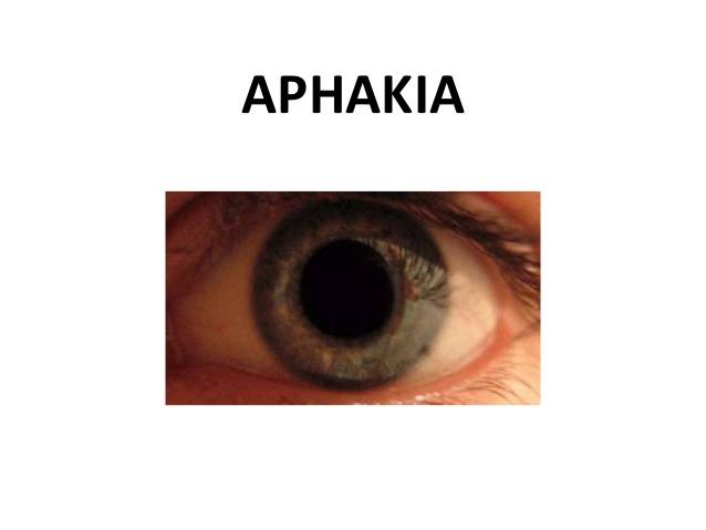 Афакия глаза: что такое, искуственный хрусталик, операция по коррекции помутнения, заболевание, функция, код мкб-10