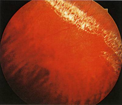 Дистрофия сетчатки глаза: что это такое, причины и лечение