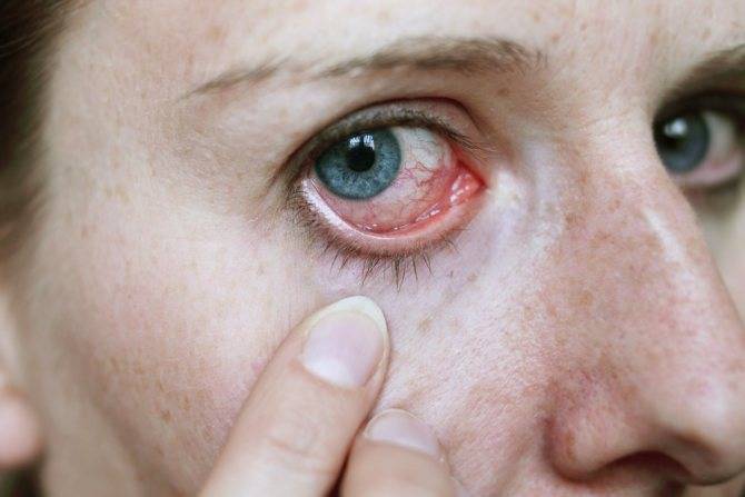 Как быстро снять покраснение глаз в домашних условиях. как убрать красноту глаз дома - womanem