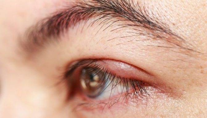 Воспаление глаза у взрослых - причины, что делать и как лечить