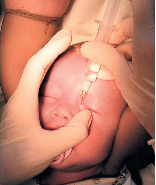 Как и для чего выполняется процедура зондирования слезного канала у новорожденных детей