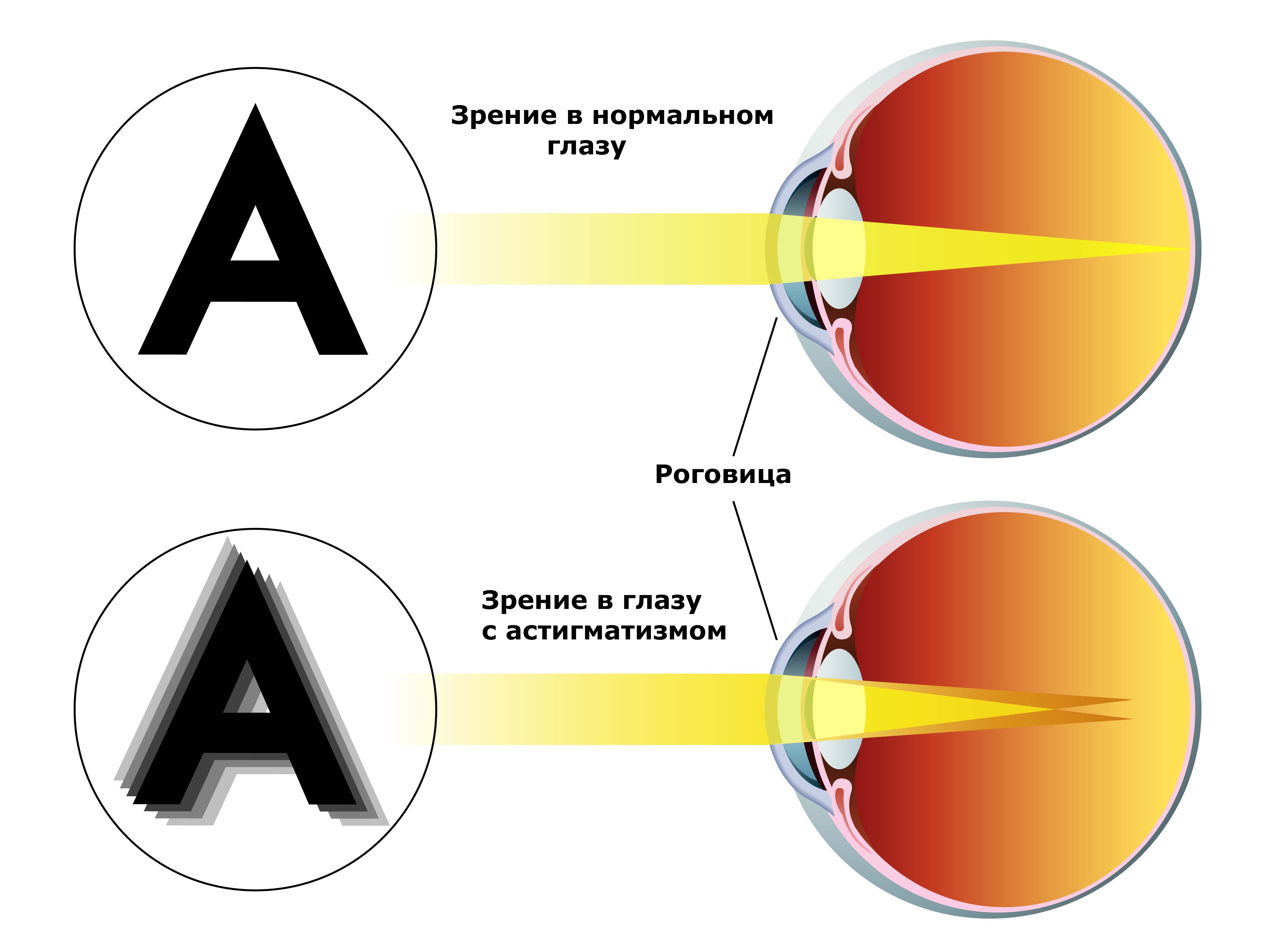 Эмметропия глаза: что это такое и виды нарушений