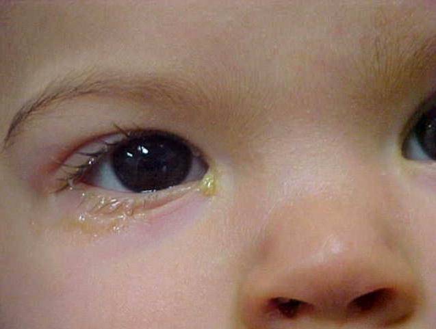 Гноятся глаза у ребенка: что делать, чем лечить и промывать в домашних условиях, почему появляется гной, температура, покраснение