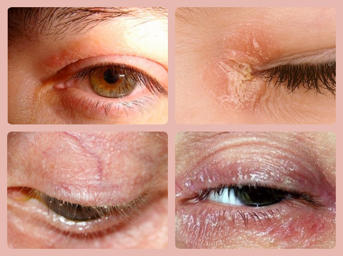 Аллергия на глазах: чем лечить, причины аллергической реакции, первые признаки и симптомы
