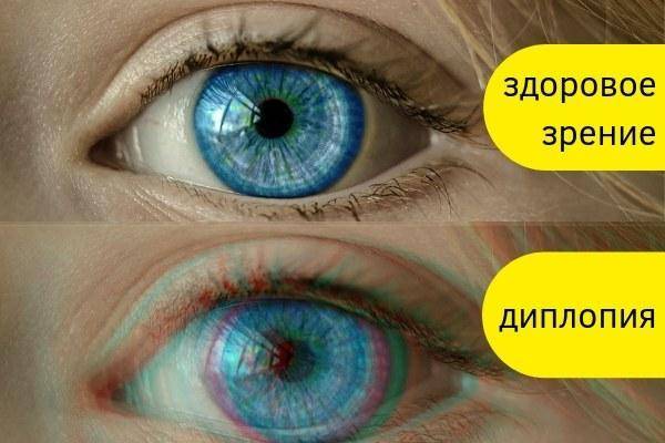 Двоение в глаза - причины, симптомы, лечение. портал vseozrenii.