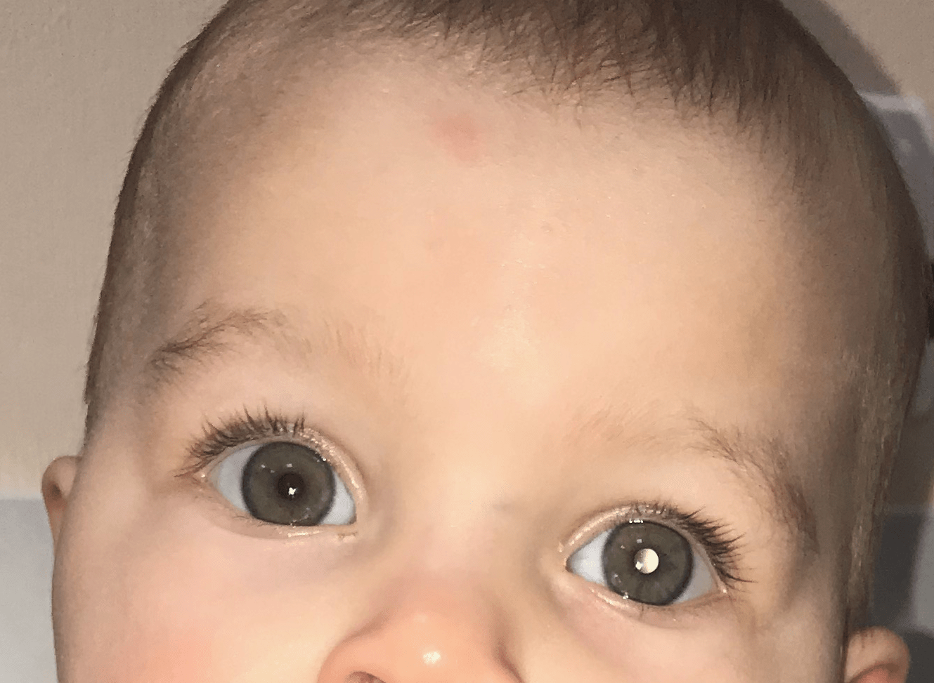 Ретинобластома глаз у детей: фото и симптомы начальной стадии