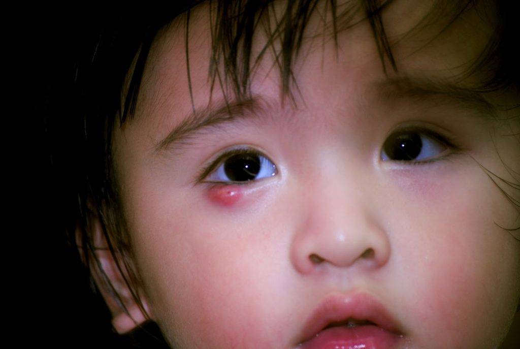 Ячмень у годовалого ребенка: чем лечить воспаление на глазу у малышей в 1 год