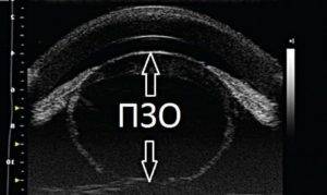 Пхрд глаза: что это такое, степени тяжести, критерии диагноза, лечение патологии обоих глаз